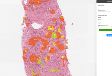 PathoViewer with Gleason score AI module